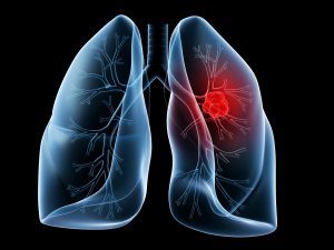 Akciğer kanserinin nedenleri